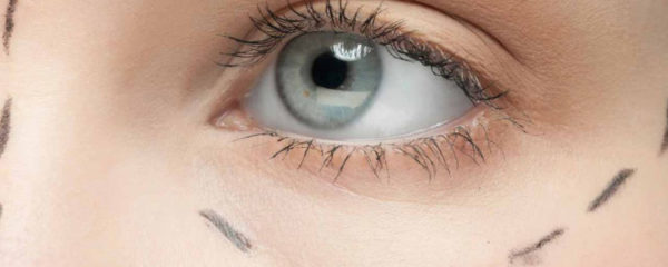 blépharoplastie