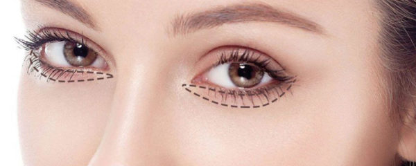 blépharoplastie